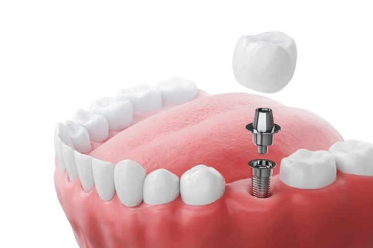 Dental Implants, STHIRA Dentistry & Facial Surgery, Dr. Bhargav Kuchu