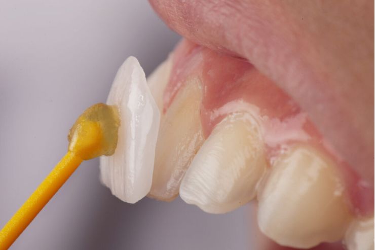 Dental Veneers STHIRA Dentistry & Facial Surgery, Dr. Bhargav Kuchu