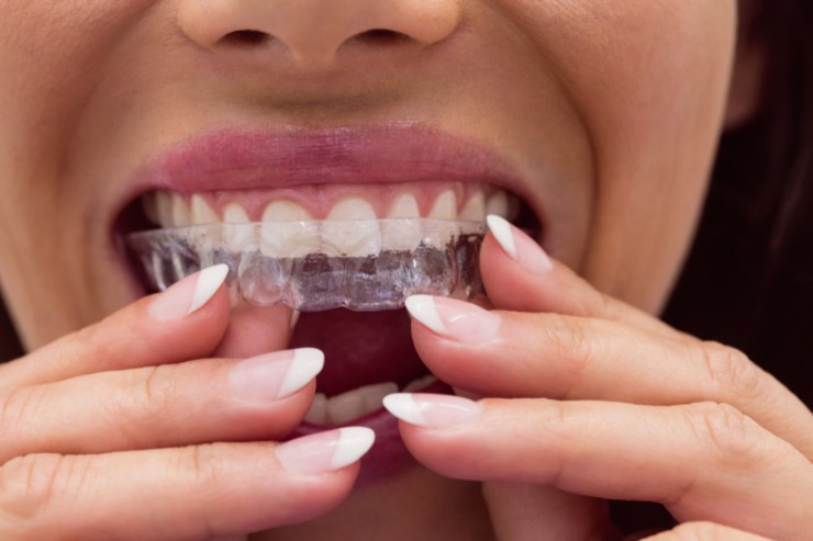 Braces STHIRA Dentistry & Facial Surgery, Dr. Bhargav Kuchu