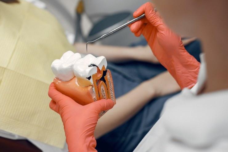 Root canal Treatment STHIRA Dentistry & Facial Surgery, Dr. Bhargav Kuchu